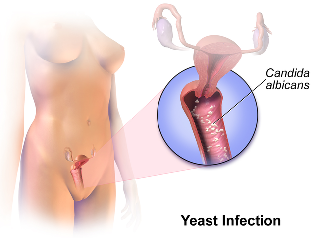 Can Probiotics & Yogurt help with (or cause) Yeast Infections?